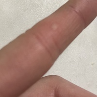 ピリピリ痛む 出来物 白い 指 Englsherty