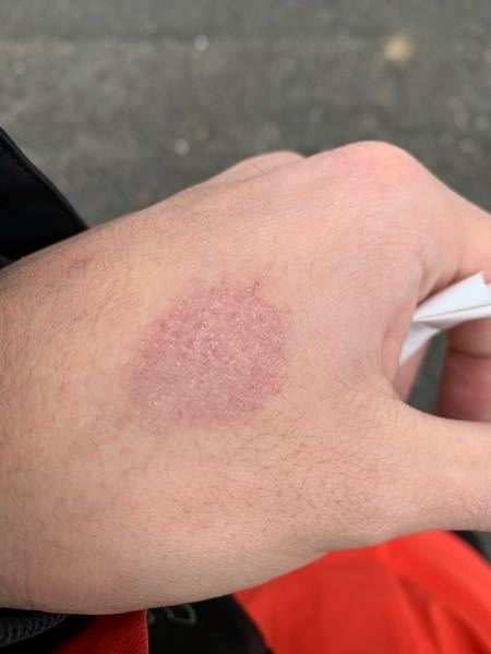 半年ほど前から手の甲が赤くかさかさしている部分があります かゆみや痛 Yahoo 知恵袋