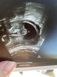 妊娠27週の画像です この写真の性別判断をしたいです 先生には男 Yahoo 知恵袋