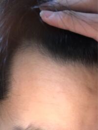 16歳です ここ半年くらいで急激に生え際が後退し 前髪が少なくな Yahoo 知恵袋