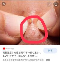 爪で押すとニュルッと鼻の毛穴から脂が出て来て楽しいです この脂って Yahoo 知恵袋