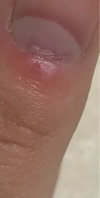 爪の白い部分 爪半月 の部分を少し深く傷をつけてしまいました Yahoo 知恵袋