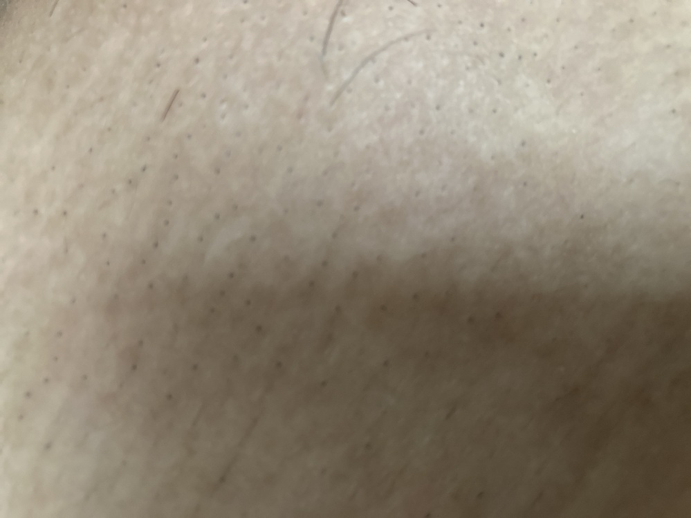 c3で脱毛に通っています。いま3回目が終わって2ヶ月ほど経ったところです。 vioのvの部分が埋没毛になってしまったのか、黒い点々になっていて毛が生えてきません。写真有りです。 爪やピンセットで引っ掻いてみると黒い汚れみたいなのが出てきます。 この点々を消す方法を知っている方はいますか？