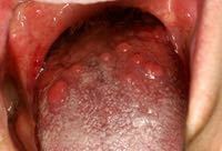 舌の奥にこんなようなのが出来ているんですが、なんなんでしょうか？ 病気でしょうか？