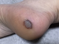 褥瘡 血豆 壊死 皮膚がん かかとに黒いアザのような 内出血のよ Yahoo 知恵袋