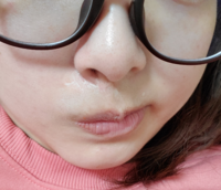 顔の傷跡を消したいです 今はケロコートを塗ってます 乾燥からは防げてて日 Yahoo 知恵袋