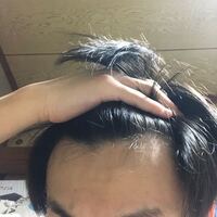 これはハゲですよね 19歳です 学校や就職関係で不安やストレスがやば Yahoo 知恵袋