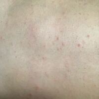 これは疥癬ですか 痒みがあって腹胸背中首腕に出来ています Yahoo 知恵袋