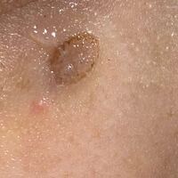 ほくろのレーザー除去を本日してきました 術後すぐの写真なの Yahoo 知恵袋