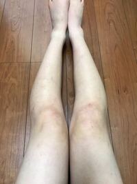 中学生です 私は本当に足が汚いです かすり傷でも残って Yahoo 知恵袋