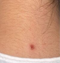 このほくろは悪性ですか 昔からあったほくろなのですが 元々は黒いホク Yahoo 知恵袋
