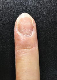 指の爪と周りの皮膚が変形してしまいました 右手の薬指で Yahoo 知恵袋