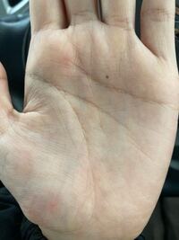 少し前から手のひらに突然ほくろが出来ました 調べると癌とか Yahoo 知恵袋