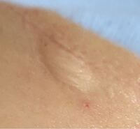 私は中３なのですが小6の頃に転んだ傷をそのままにしていたらぷっくりとあとが Yahoo 知恵袋