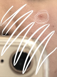 丸で囲んであるニキビの治し方教えてください たぶん黄ニキビだと思 Yahoo 知恵袋