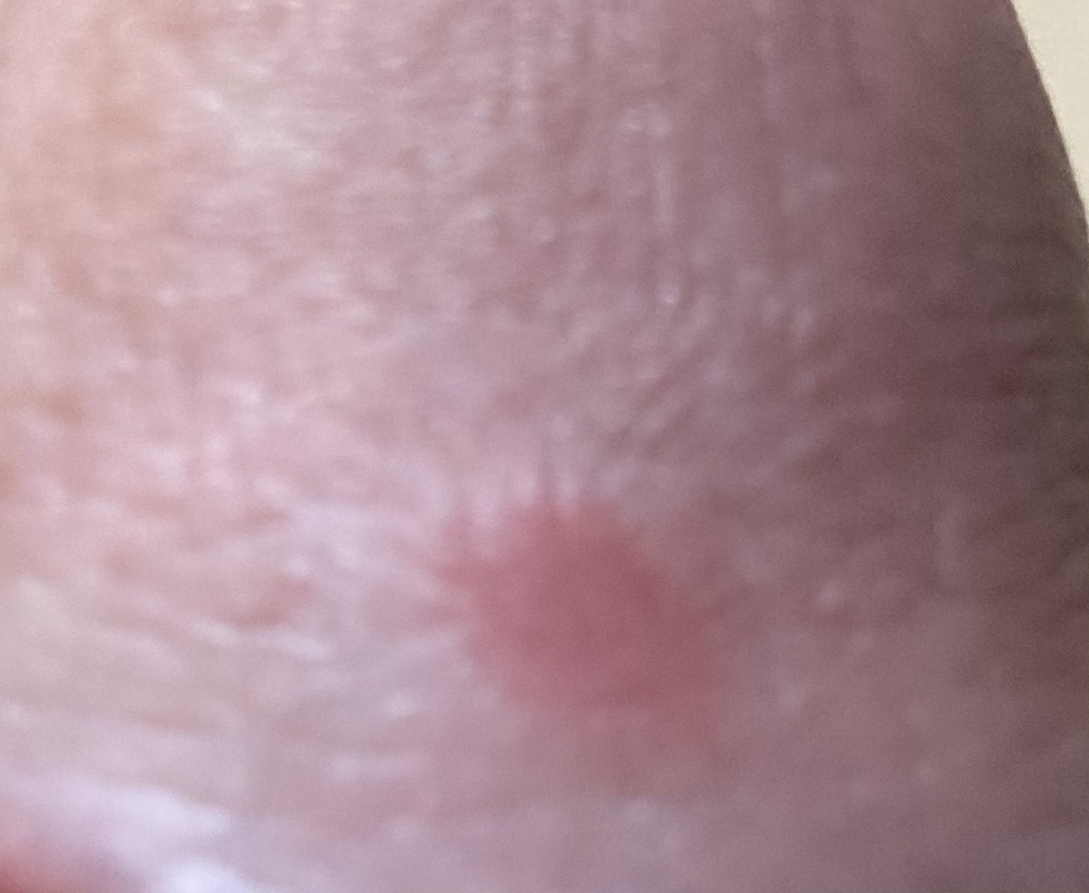 亀頭に急に赤い湿疹の様な物が出来ました 何だかわかりますでしょうか 痛みや Yahoo 知恵袋