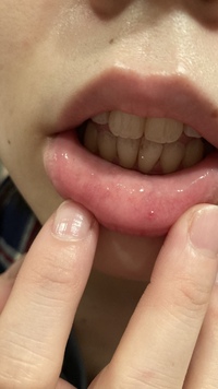 唇の内側にポコっとしたものができているのですが これって何ですか Yahoo 知恵袋