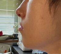 口周りがコンプレックスです これはアデノイドまたは口ごぼというや Yahoo 知恵袋
