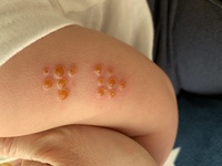 現在10ヶ月の子供です 5ヶ月の頃にbcgを接種したのですが 最 Yahoo 知恵袋