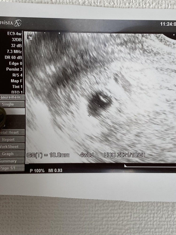 妊娠初期エコー写真について閲覧ありがとうございます。先日、病院を 