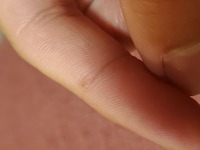 いぼに液体質素かけて皮膚が黒くなってるんですけど大丈夫ですか あくまで Yahoo 知恵袋