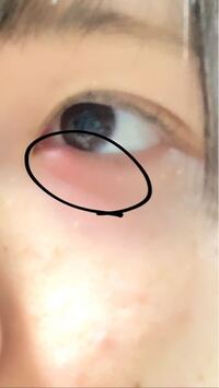 右目の涙袋が土曜日から腫れています 今そんなに痛くないのですが 日曜日 Yahoo 知恵袋