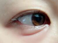 突然目の下が赤く腫れてしまいました 先日も腫れて眼科に行きましたが Yahoo 知恵袋