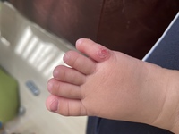 生後5ヶ月の赤ちゃんの足の指にかさぶたみたいなものが出来ていて剥 Yahoo 知恵袋