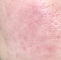 顔が何年も赤いのですがこれは何か病気でしょうか 病院ではニキビかなと Yahoo 知恵袋