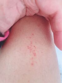 痒くて放置してたらこのようになってたのですがこれはトコジラミの噛 Yahoo 知恵袋