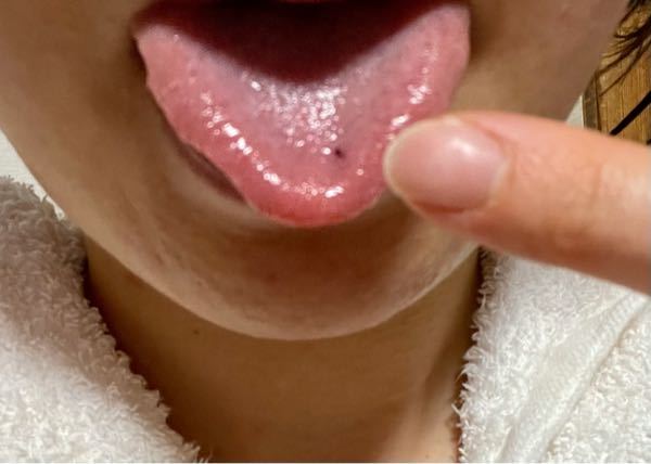 舌に小さい赤い血豆のようなものが 写真あり 代女です いまふと Yahoo 知恵袋