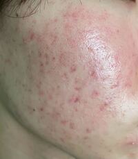 このニキビ跡はどういうタイプのニキビ跡なんでしょうか 色素沈着してま Yahoo 知恵袋