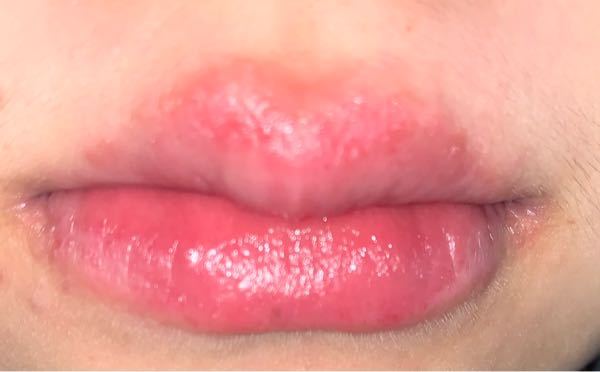 代前半 女 唇荒れ病院皮膚科 3ヶ月程前から唇の荒れが酷 Yahoo 知恵袋