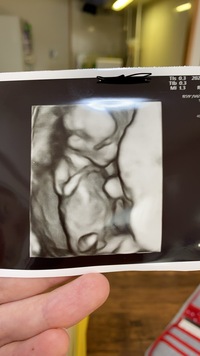 現在妊娠14週です 女の子を希望しているのですが このエコー写真から性別わ Yahoo 知恵袋