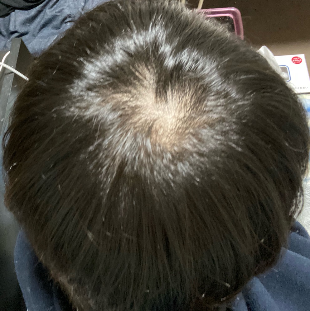 最近つむじが凄く気になるようになりました。元々美容師からは「猫っ毛 