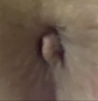 汚い写真ですみません 25歳女です お尻の穴からぷにぷにしたもの Yahoo 知恵袋