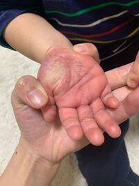 1歳2ヶ月の子供の手の平が内出血 のような 紫色っぽくなって Yahoo 知恵袋