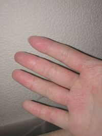 指の皮膚トラブル 利き手の右手だけこのように荒れていてプツプツみたいな Yahoo 知恵袋