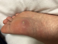 3日ほど前に畳の上を裸足で歩いたせいか 畳のトゲが刺さってしまい Yahoo 知恵袋