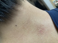 これはなんでしょう 2センチくらいの塊でブツブツできてます かゆくも痛くも Yahoo 知恵袋