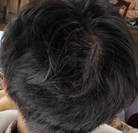 受験のストレスや不健康な生活で後頭部が薄くなってしまったのですが これはつ Yahoo 知恵袋