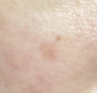 ホクロ除去をし キズパワーパッドを三週間ほど貼っていました 上皮化が進ん Yahoo 知恵袋