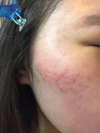 肌荒れが酷いのですがどうすればいいですか ニキビでしょうか Yahoo 知恵袋