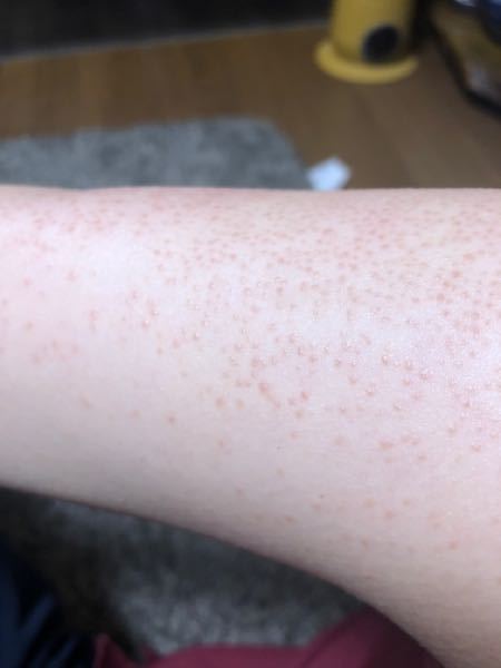サメ肌についての質問 18歳女子です上にもある通り私は生まれ Yahoo 知恵袋