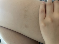 お見苦しいのですが このように掻いた跡が残ってしまうのですがこの Yahoo 知恵袋