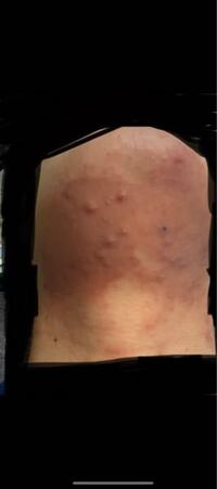 アダパレンゲルという薬を一週間ほど使っているんですけどこれは副作用ですか Yahoo 知恵袋