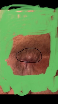 汚い画像で申し訳ありません これは痔でしょうか 痛みは若干あります Yahoo 知恵袋