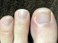 閲覧注意 これは爪周囲炎ですか 足の親指の爪の付け根の赤い部分が痛いです Yahoo 知恵袋