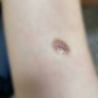 １年前粉瘤が膿んでしまい膿を出して次回袋を取ると言われたのですが前回のがと Yahoo 知恵袋
