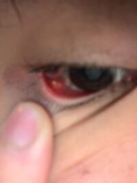 まぶた裏ニキビ まぶたの裏にニキビのようなものがあります こ Yahoo 知恵袋